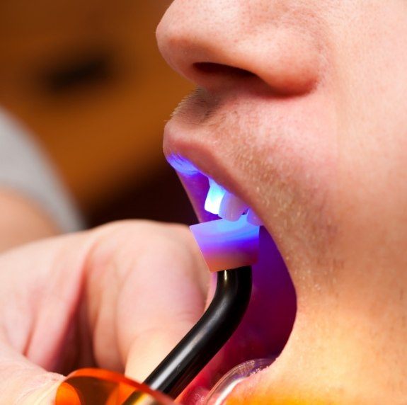 Close up of dental patient getting cosmetic bonding on front upper tooth