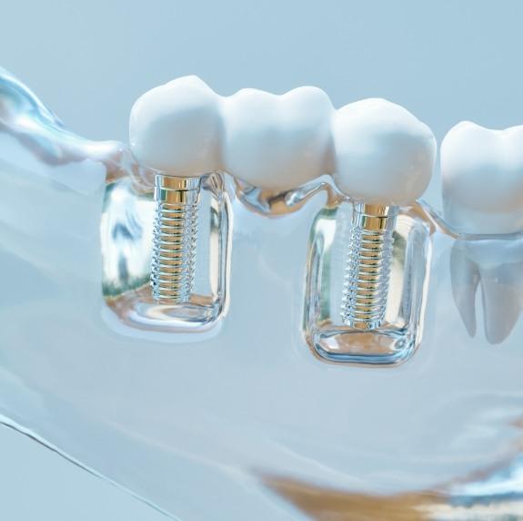 Model of a mouth with two dental implants in Durham