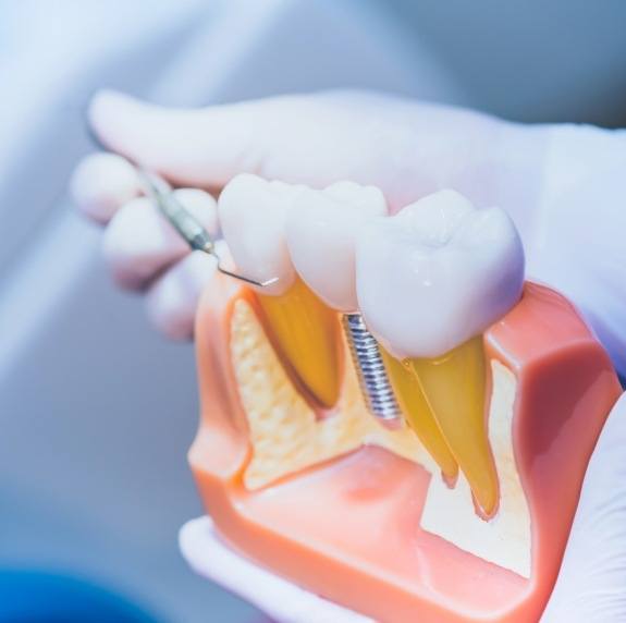 Dentist holding a dental implant model