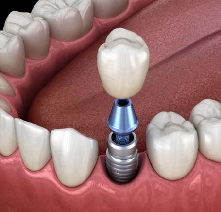 Illustrated dental crown being placed onto a dental implant