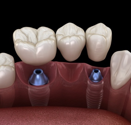 Illustrated dental bridge being placed onto two dental implants