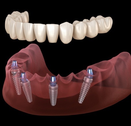 Illustrated full denture  being placed onto four dental implants