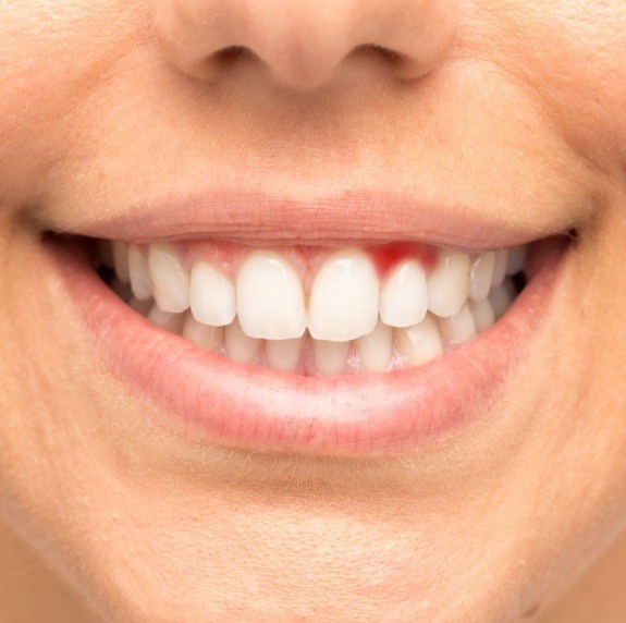 Close up of smile with red spot in gums before gum disease treatment in Durham