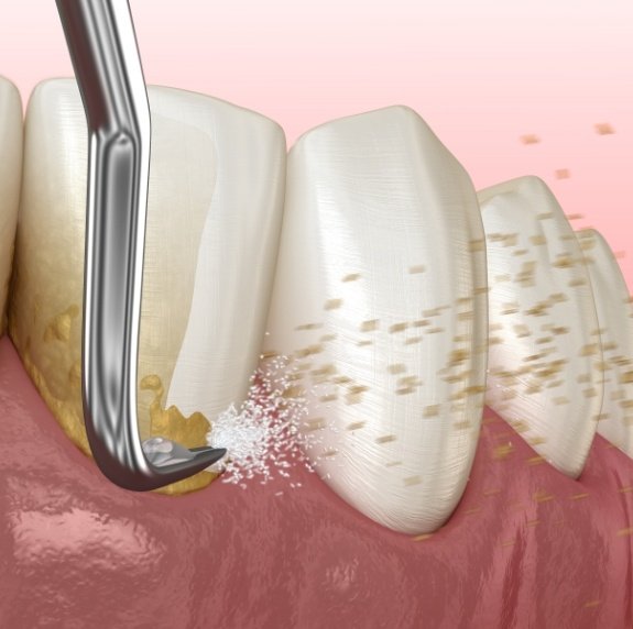 Illustrated dental instrument clearing plaque buildup from teeth