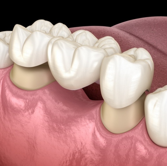 Illustrated dental bridge replacing a missing tooth in Durham