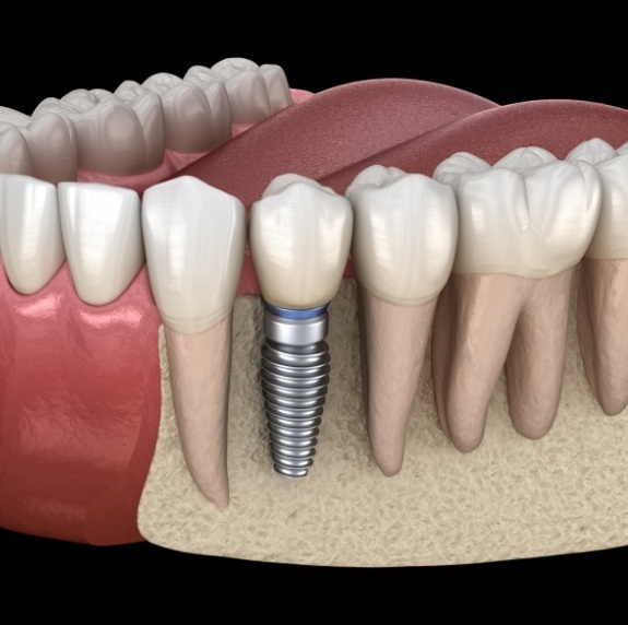 Illustrated dental implant replacing a missing lower tooth