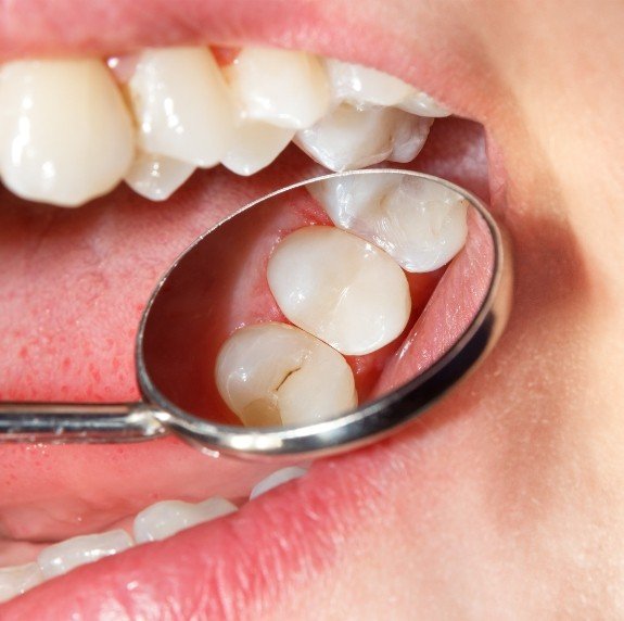 Close up of dental mirror in mouth reflecting a tooth