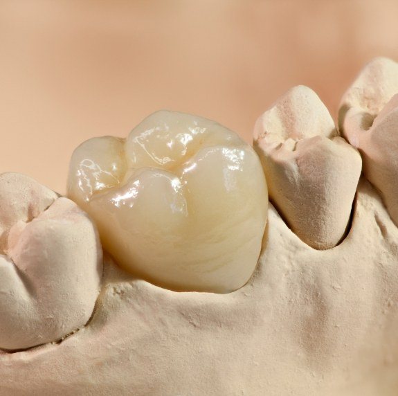 Model of the teeth with a dental crown fitted over one tooth