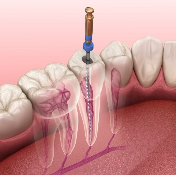 Illustrated dental instrument treating the inside of a tooth during root canal treatment