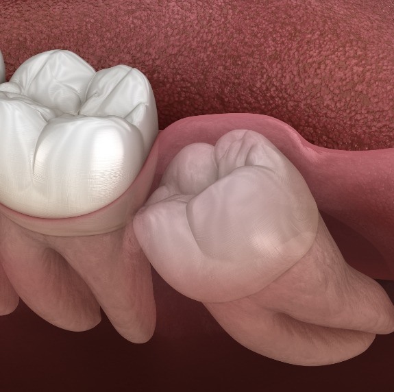 Illustrated impacted wisdom tooth pressing against molar